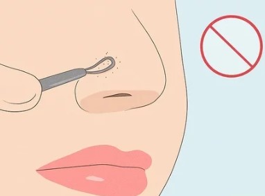 blackhead removal