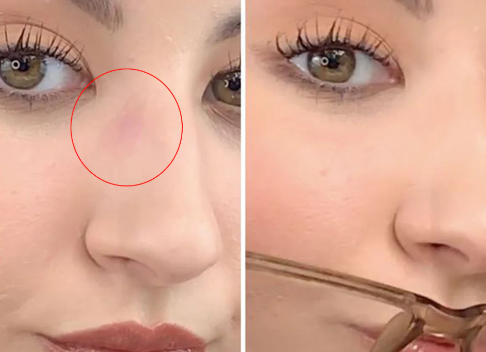 how to get rid of glasses marks on nose